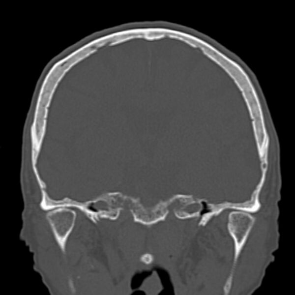 File:Biparietal osteodystrophy (Radiopaedia 46109-50463 Coronal bone window 55).jpg