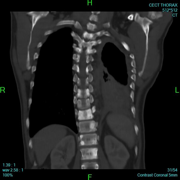 File:Bone metastases from lung carcinoma (Radiopaedia 54703-60937 Coronal bone window 31).jpg