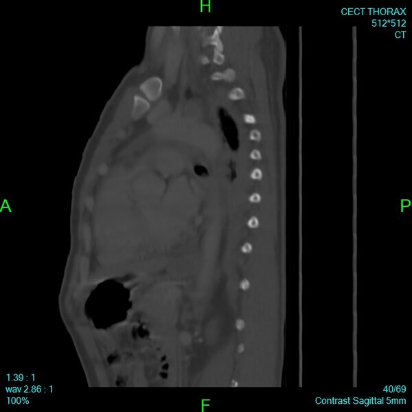 File:Bone metastases from lung carcinoma (Radiopaedia 54703-60937 Sagittal bone window 40).jpg