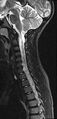 Brachial plexus birth palsy (Radiopaedia 68118-77604 Sagittal T2 6).jpg