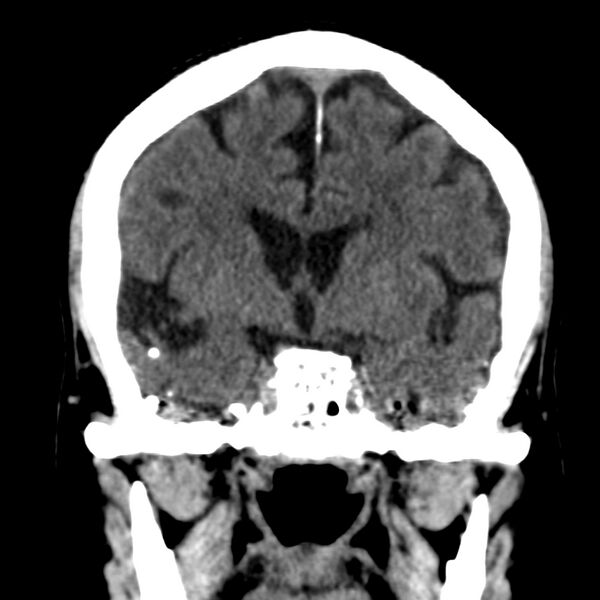 File:Brain Pantopaque remnants (Radiopaedia 78403-91048 Coronal non-contrast 32).jpg