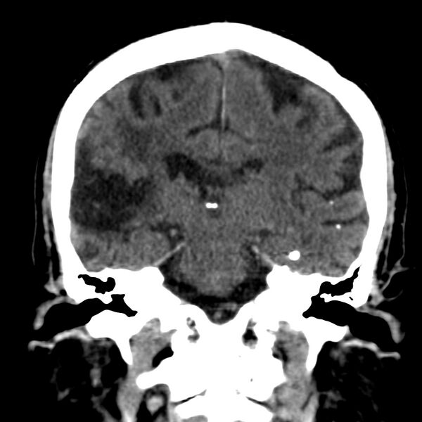 File:Brain Pantopaque remnants (Radiopaedia 78403-91048 Coronal non-contrast 41).jpg