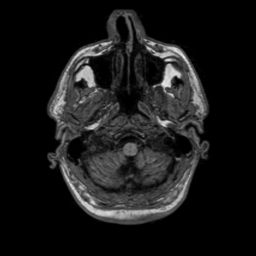 Brain abscess complicated by intraventricular rupture and ventriculitis (Radiopaedia 82434-96577 Axial T1 3).jpg