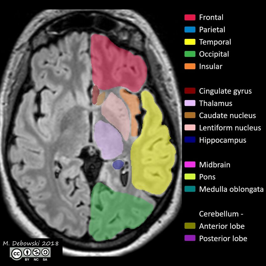 Brain lobes - annotated MRI (Radiopaedia 61691-69700 Axial 41).JPG