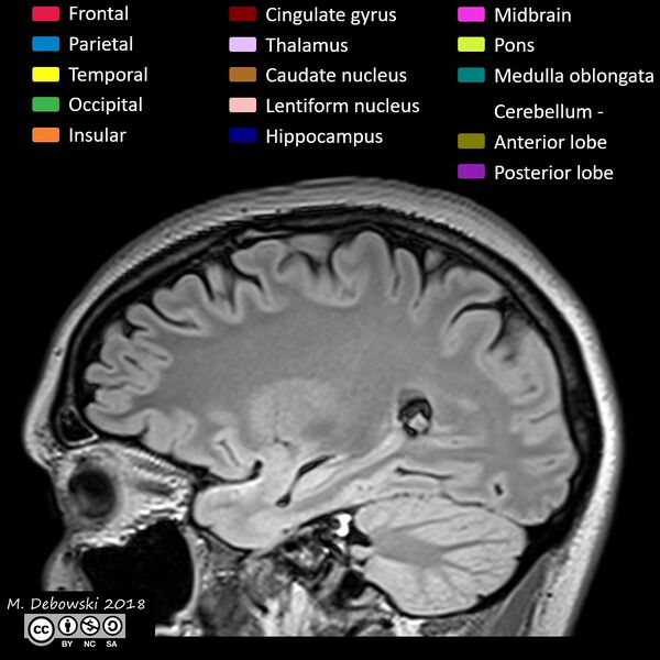 File:Brain lobes - annotated MRI (Radiopaedia 61691-69700 Sagittal 24).JPG