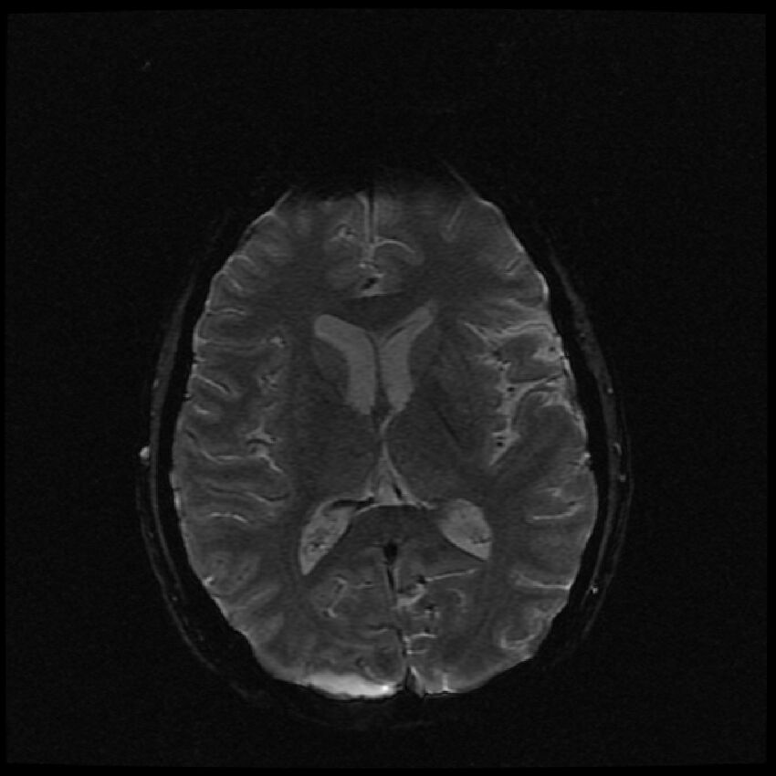 Brain metastases (renal cell carcinoma) (Radiopaedia 42571-45704 Axial SWI 28).jpg