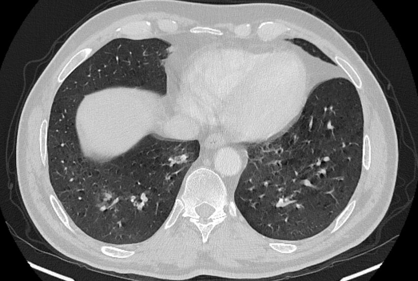 Brain metastases - lung cancer primary (Radiopaedia 75060-86116 Axial lung window 46).jpg