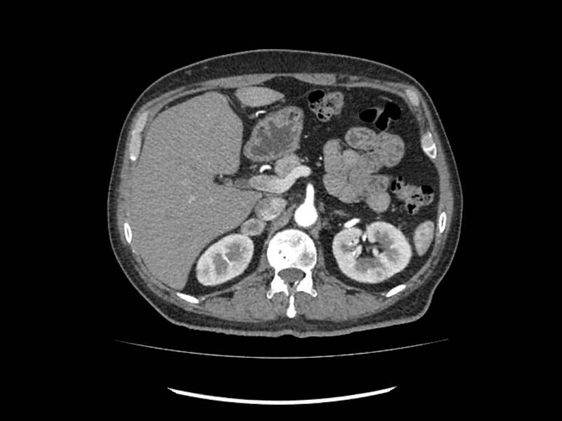 File:Brain metastases from renal cell carcinoma (Radiopaedia 42222-45328 A 49).jpg
