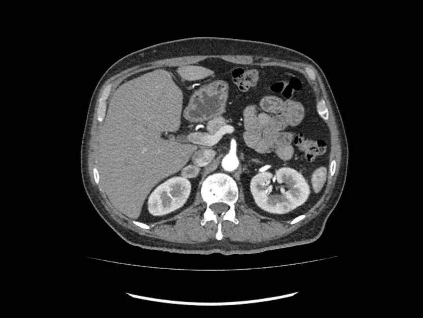 Brain metastases from renal cell carcinoma (Radiopaedia 42222-45328 A 49).jpg