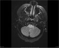 Brainstem glioma (Radiopaedia 21819-21775 Axial FLAIR 7).jpg