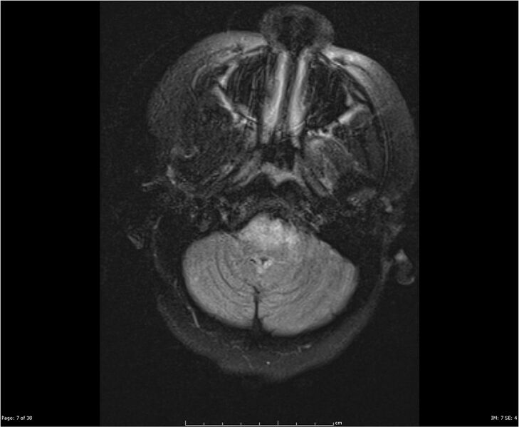 File:Brainstem glioma (Radiopaedia 21819-21775 Axial FLAIR 7).jpg