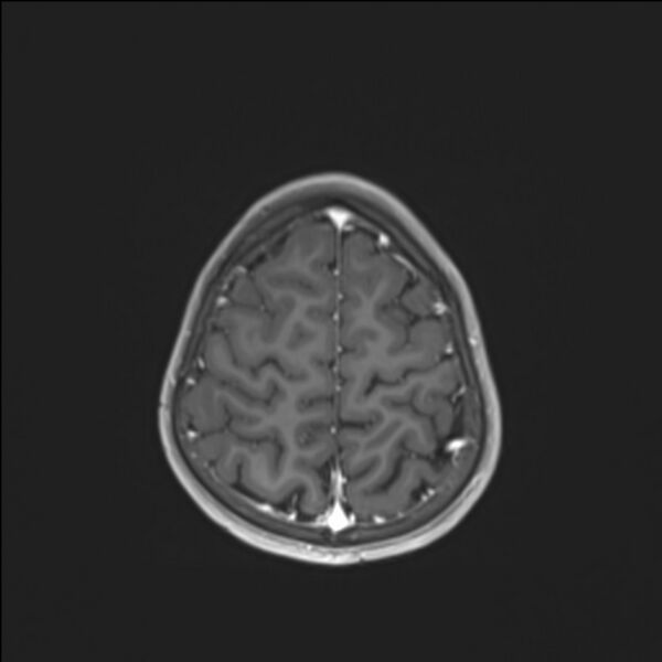 File:Brainstem glioma (Radiopaedia 70548-80674 Axial T1 C+ 131).jpg