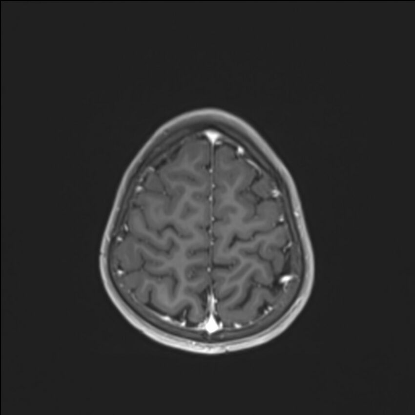 Brainstem glioma (Radiopaedia 70548-80674 Axial T1 C+ 131).jpg