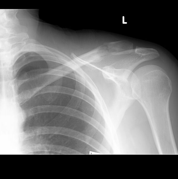 File:Breast cancer metastasis to distal clavicle - pathological fracture (Radiopaedia 12544-12761 Frontal 1).jpg