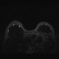 Breast implants - MRI (Radiopaedia 26864-27035 T2 SPAIR 19).jpg