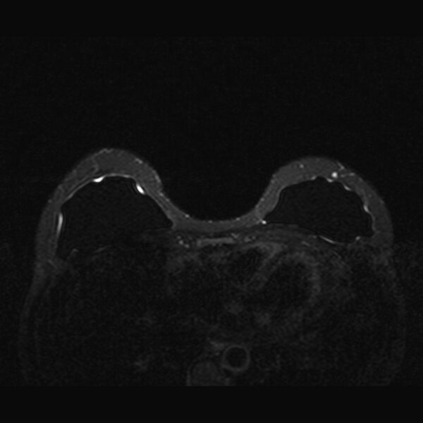 File:Breast implants - MRI (Radiopaedia 26864-27035 T2 SPAIR 19).jpg