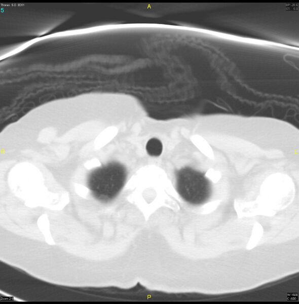 File:Breast primary with lung and bone metastases (Radiopaedia 40620-43228 Axial lung window 5).jpg