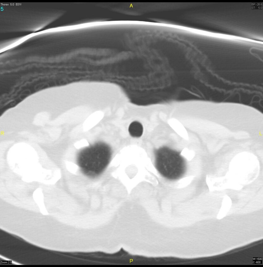 Breast primary with lung and bone metastases (Radiopaedia 40620-43228 Axial lung window 5).jpg