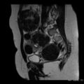 Broad ligament fibroid (Radiopaedia 49135-54241 Sagittal T2 9).jpg