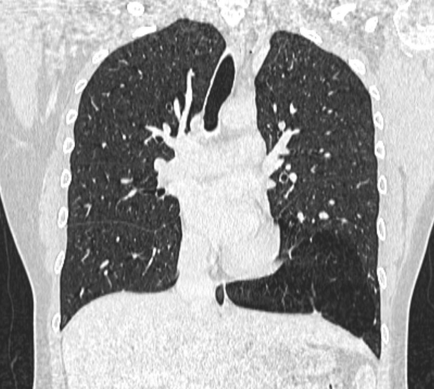 Bronchial atresia (Radiopaedia 50007-55297 Coronal lung window 50).jpg