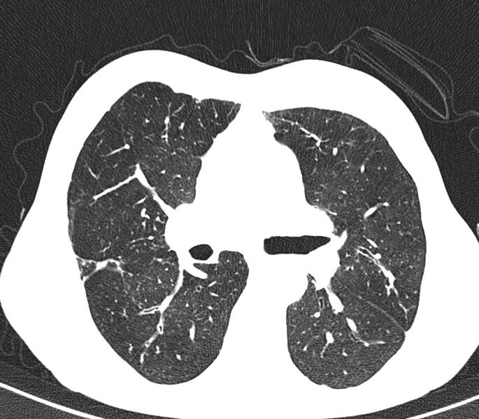 File:Bronchiolitis (Radiopaedia 24616-24887 Axial lung window 25).jpg