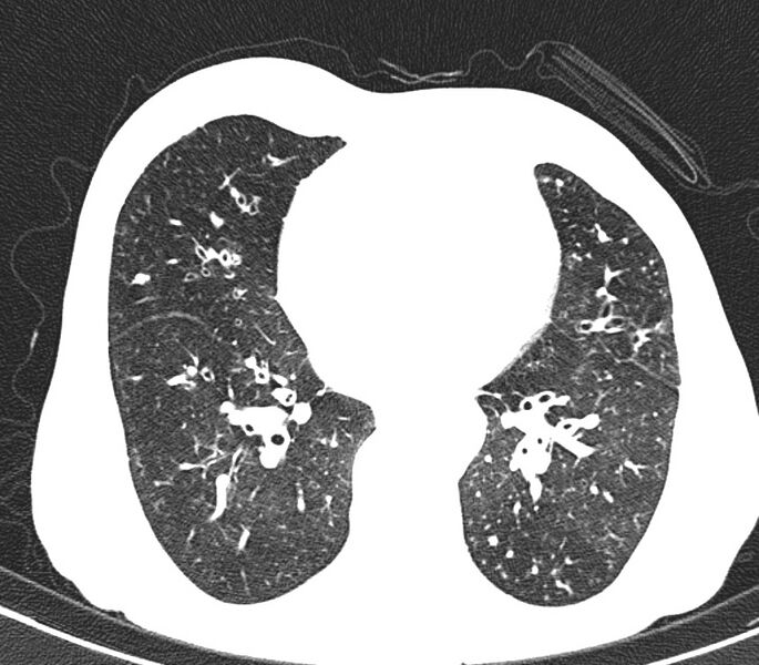 File:Bronchiolitis (Radiopaedia 24616-24887 Axial lung window 36).jpg
