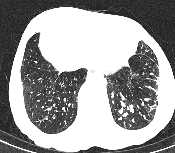 File:Bronchiolitis (Radiopaedia 24616-24887 Axial lung window 50).jpg