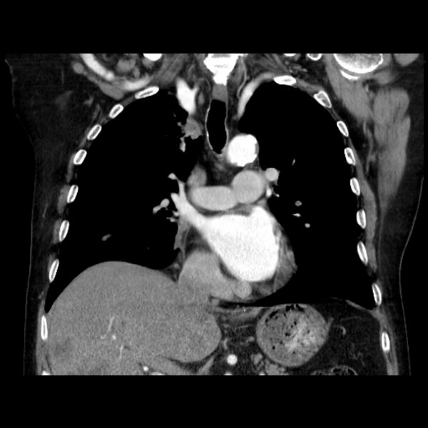 File:Bronchogenic adenocarcinoma and pulmonary embolism (Radiopaedia 9097-9806 C 24).jpg