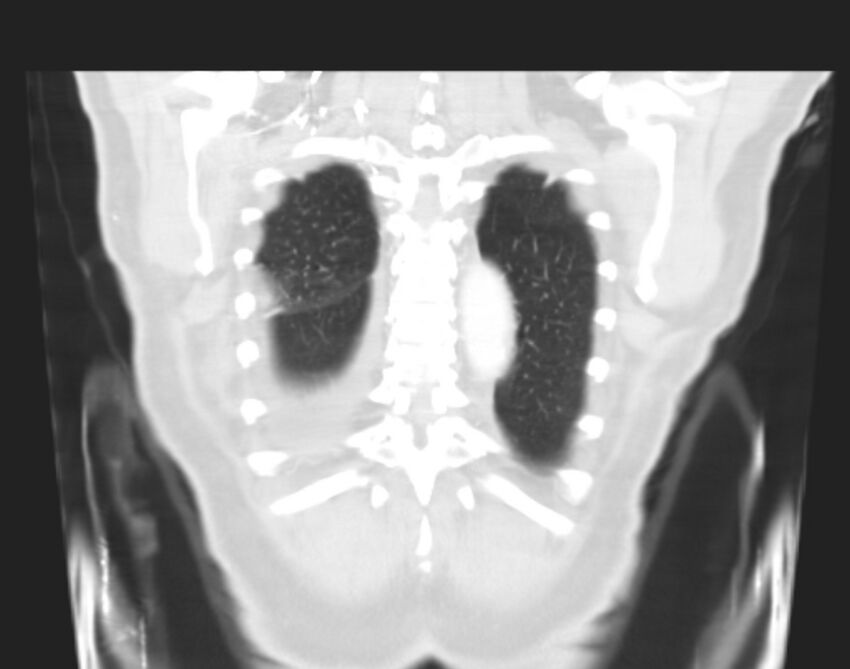 Bronchogenic carcinoma with lymphangitic spread (Radiopaedia 29002-29357 Coronal lung window 64).jpg