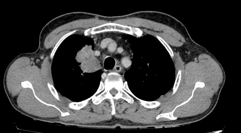 File:Bronchogenic carcinoma with superior vena cava syndrome (Radiopaedia 36497-38054 Axial C+ delayed 20).jpg