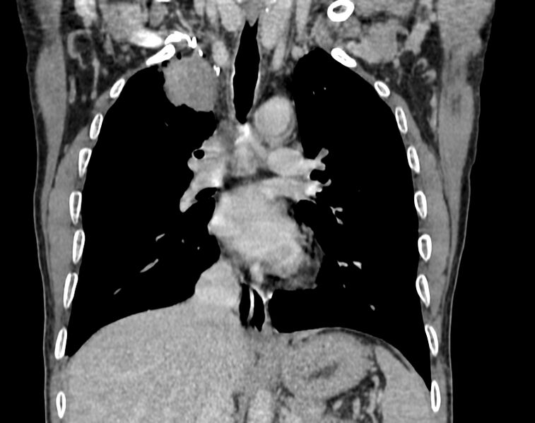File:Bronchogenic carcinoma with superior vena cava syndrome (Radiopaedia 36497-38054 Coronal C+ delayed 42).jpg