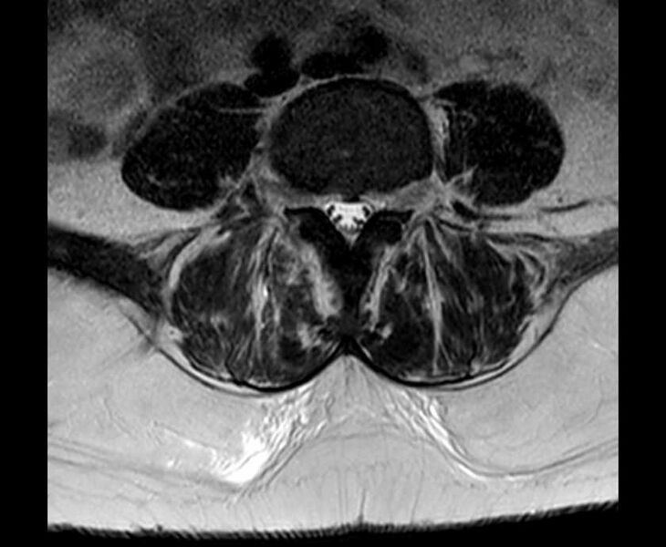 File:Brown tumors compressing the spinal cord (Radiopaedia 68442-78030 Axial T2 - lumbar 21).jpg