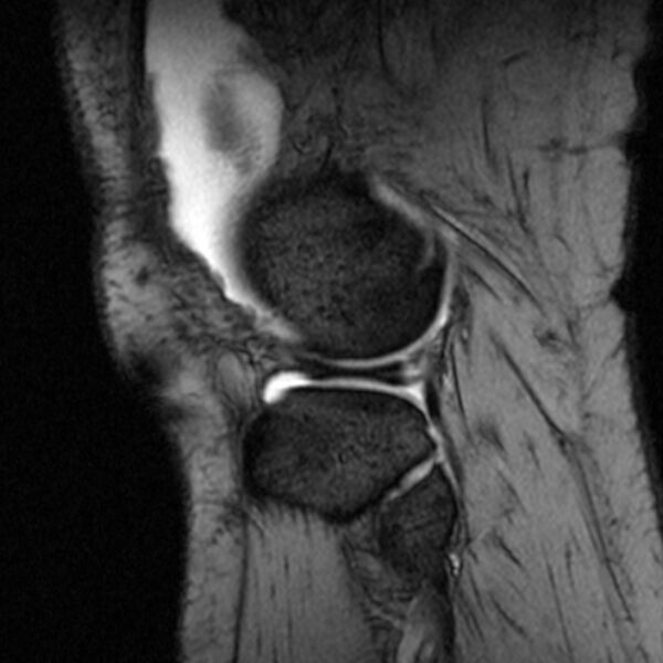 File:Bucket handle tear - medial meniscus (Radiopaedia 79028-91942 D 4).jpg