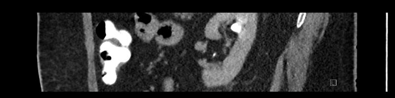 File:Buried bumper syndrome - gastrostomy tube (Radiopaedia 63843-72575 Sagittal Inject 38).jpg