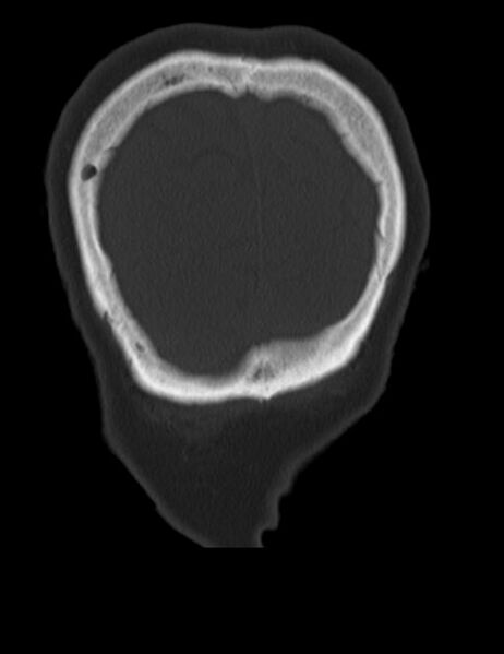 File:Burnt-out meningioma (Radiopaedia 51557-57337 Coronal bone window 50).jpg