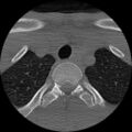 C5 facet fracture (Radiopaedia 58374-65499 Axial bone window 96).jpg