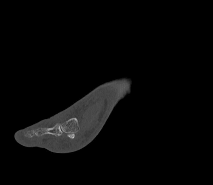 Calcaneal tuberosity avulsion fracture (Radiopaedia 22649-22668 Sagittal bone window 48).jpg