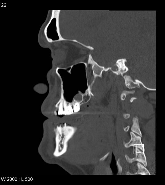 File:Calcification of the transverse band of the cruciform ligament (Radiopaedia 53063-59025 Sagittal bone window 3).jpg