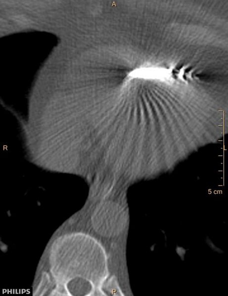 File:Calcified cardiac fibroma (Radiopaedia 39267-41519 Axial bone window 17).jpg