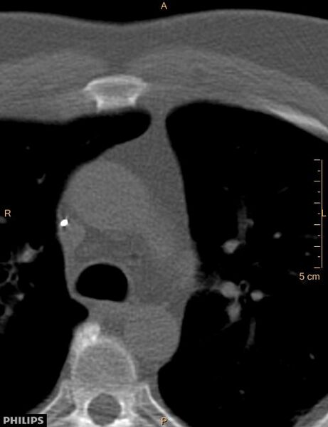 File:Calcified cardiac fibroma (Radiopaedia 39267-41519 Axial bone window 5).jpg