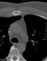 Calcified cardiac fibroma (Radiopaedia 39267-41519 Axial bone window 5).jpg