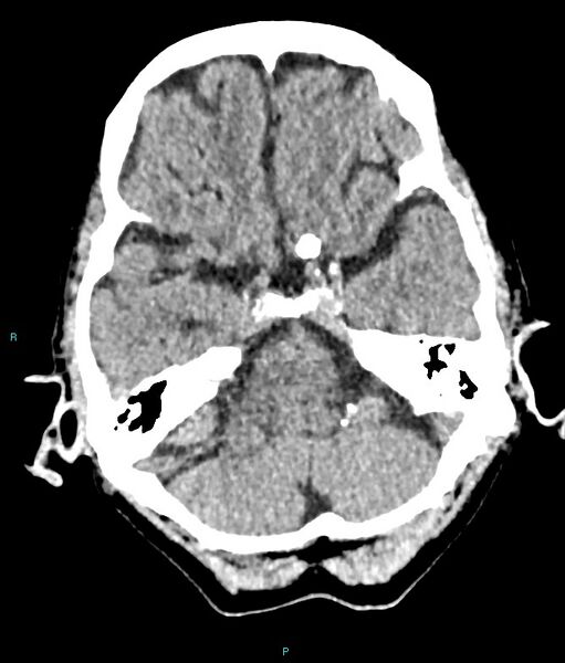 File:Calcified cerebral emboli from left ventricular thrombus (Radiopaedia 84420-99758 Axial non-contrast 70).jpg