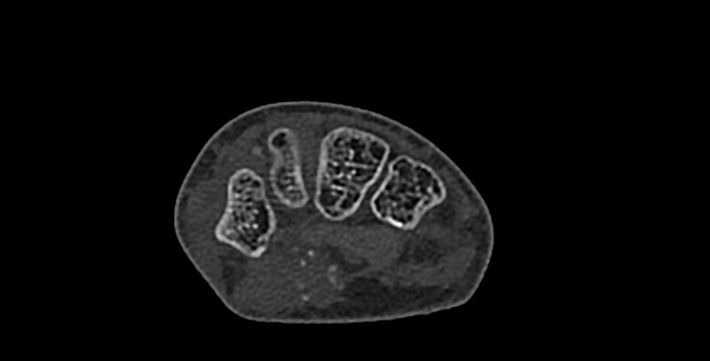 File:Calcifying aponeurotic fibroma (Radiopaedia 88423-105064 Axial bone window 100).jpg