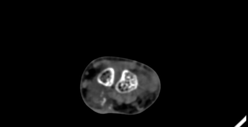 File:Calcifying aponeurotic fibroma (Radiopaedia 88423-105064 B 54).jpg