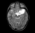 Callosal dysgenesis and ectopic posterior pituitary (Radiopaedia 8382-9213 Axial T2 10).jpg