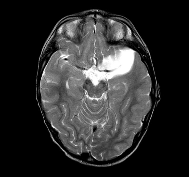 File:Callosal dysgenesis and ectopic posterior pituitary (Radiopaedia 8382-9213 Axial T2 10).jpg