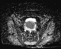 Cancer cervix - stage IIb (Radiopaedia 75411-86615 Axial ADC 18).jpg