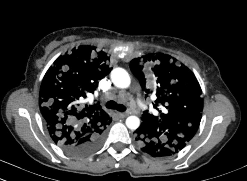 File:Cannonball metastases from breast cancer (Radiopaedia 91024-108569 A 46).jpg