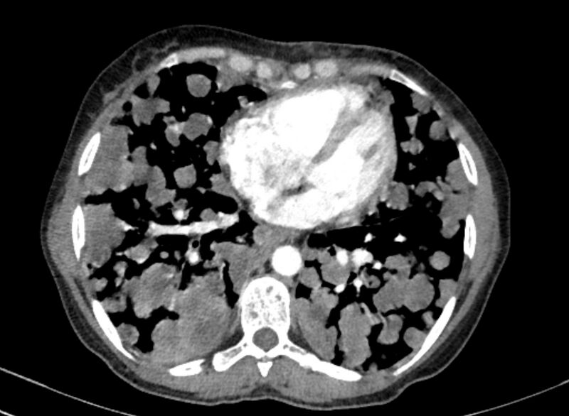 File:Cannonball metastases from breast cancer (Radiopaedia 91024-108569 A 79).jpg