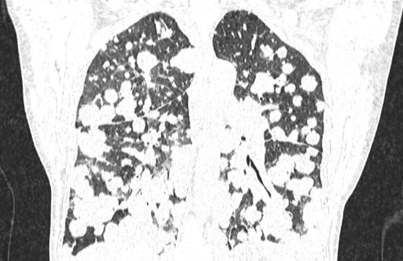 File:Cannonball metastases from breast cancer (Radiopaedia 91024-108569 Coronal lung window 93).jpg